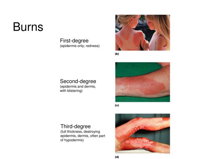 1st degree burn vs 2nd