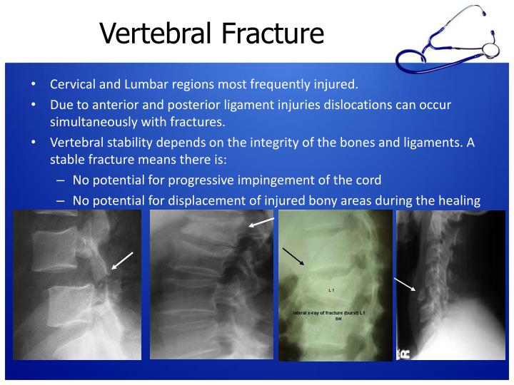 PPT - Spinal/Neck Trauma PowerPoint Presentation - ID:5384177