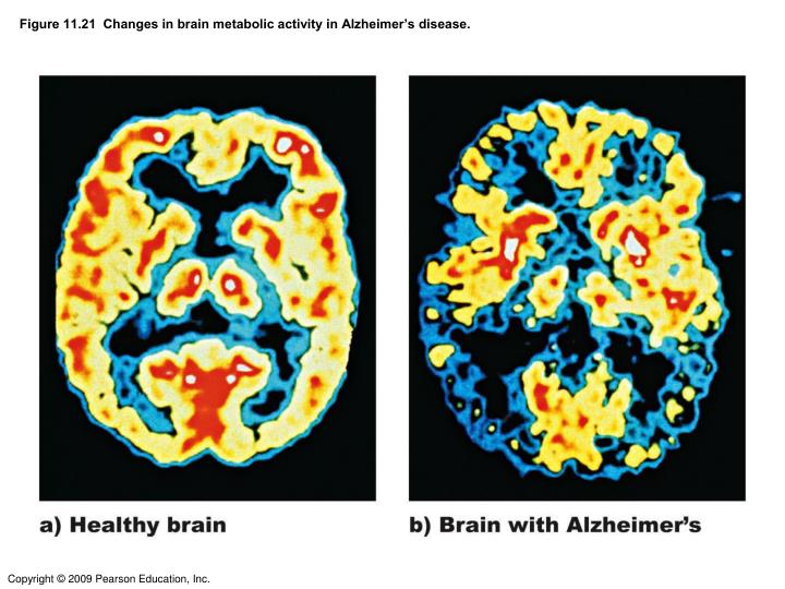 Assignment about alzheimer disease