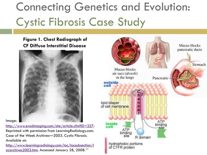 case study cystic fibrosis worksheet answers case study cystic fibrosis worksheet answers