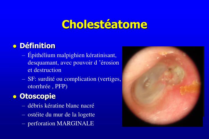 PPT - Otalgie Otites PowerPoint Presentation - ID:5597849 PPT - Otalgie Otites PowerPoint Presentation - ID:5597849