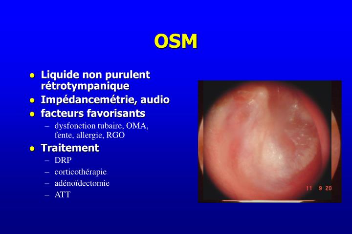 PPT - Otalgie Otites PowerPoint Presentation - ID:5597849 PPT - Otalgie Otites PowerPoint Presentation - ID:5597849