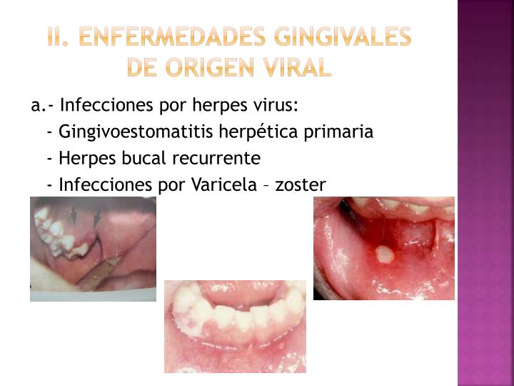 PPT - CLASIFICACION DE LA ENFERMEDAD PERIODONTAL DE ACUERDO A LA A.A.P ...