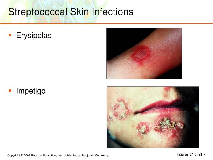 Streptococcal infections - NHS Choices