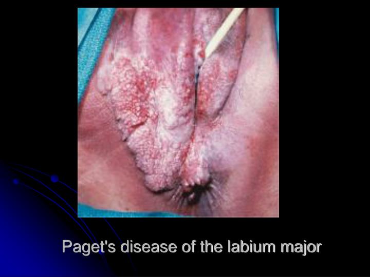 Padgetts disease of vulva French indiana lick travel