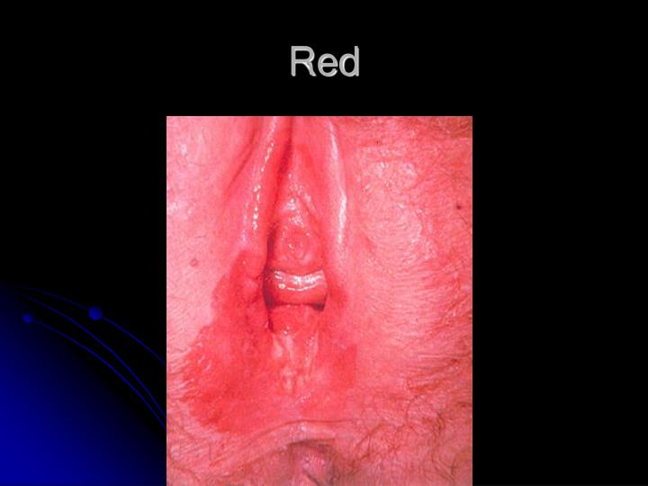 lesions cancer of white Picture vulva