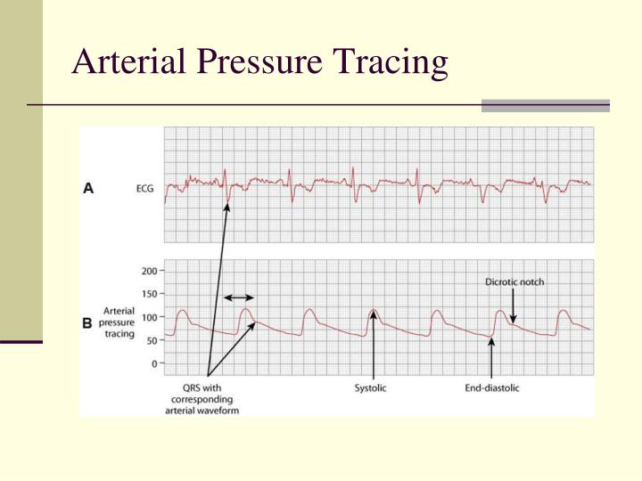 Evitar Hipertensión arterial