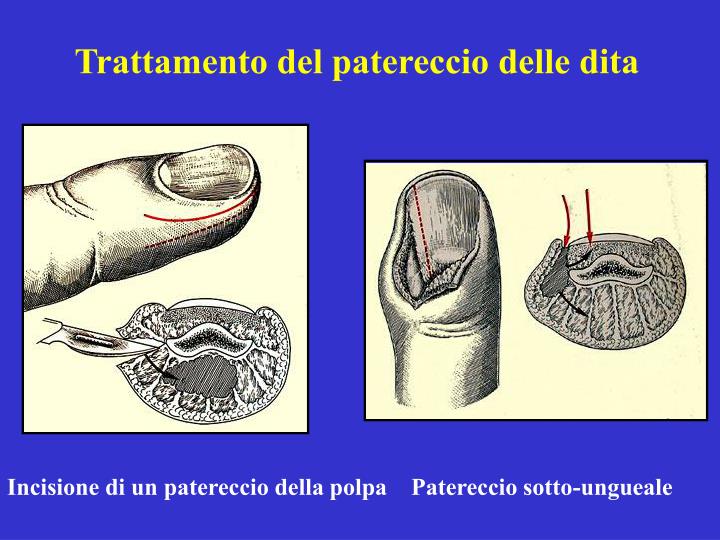 Quello che le cause diminuiscono in una potenzialità