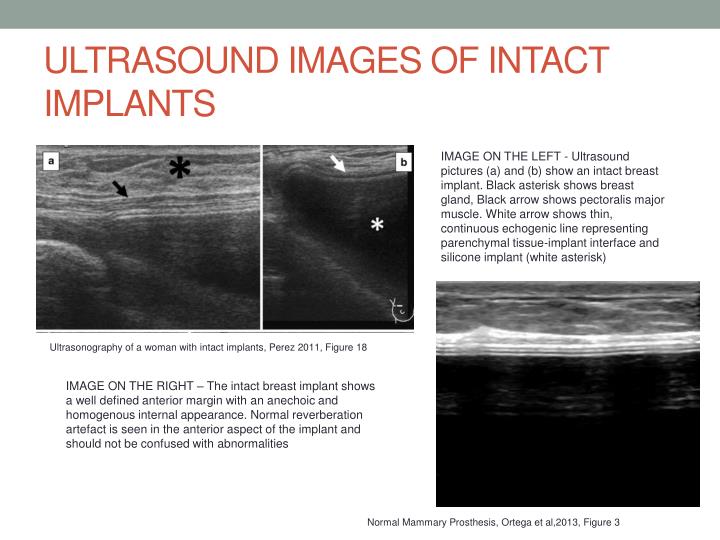 Ppt Breast Implant Rupture Powerpoint Presentation Id 6071273