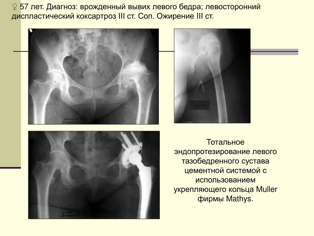 Врожденный вывих бедра презентация