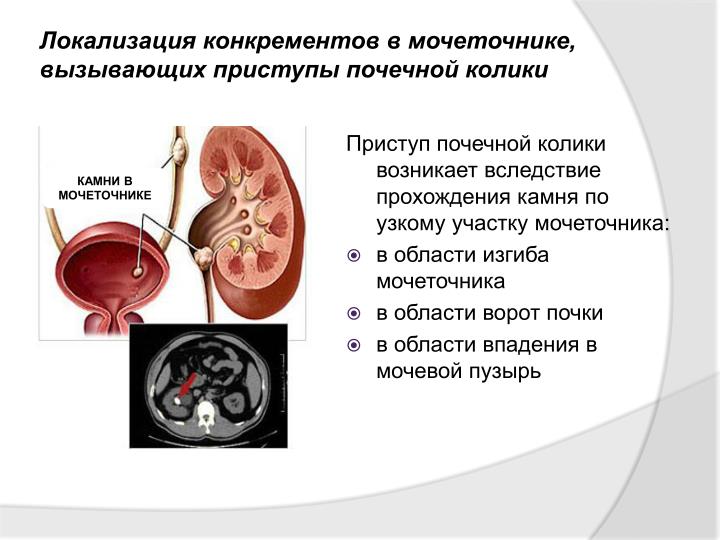 Как снять приступ почечный в домашних условиях Как снять приступ почечный в домашних условиях