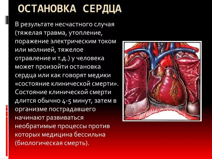 Остановка сердца в домашних условиях Остановка сердца в домашних условиях