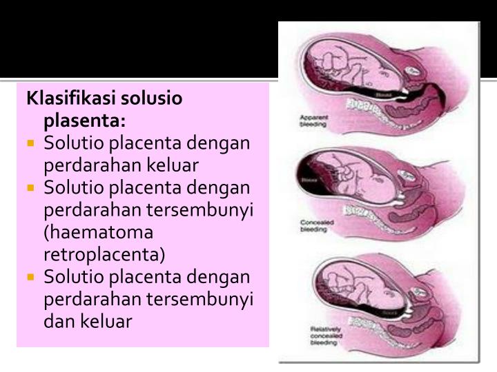 Ppt Perdarahan Antepartum Powerpoint Presentation Id 6168371