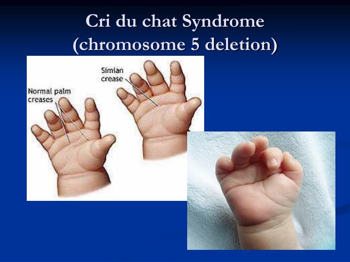 cri du chat syndrome An important gene associated with cri-du-chat syndrome is ctnnd2 (catenin delta 2) affiliated tissues include heart, eye and testes. cri du chat syndrome An important gene associated with cri-du-chat syndrome is ctnnd2 (catenin delta 2) affiliated tissues include heart, eye and testes.