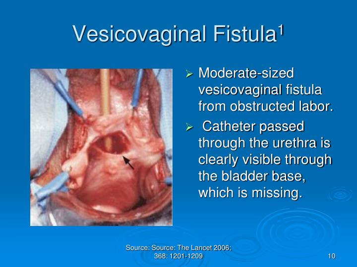 Vaginal Fistula Symptoms 6714