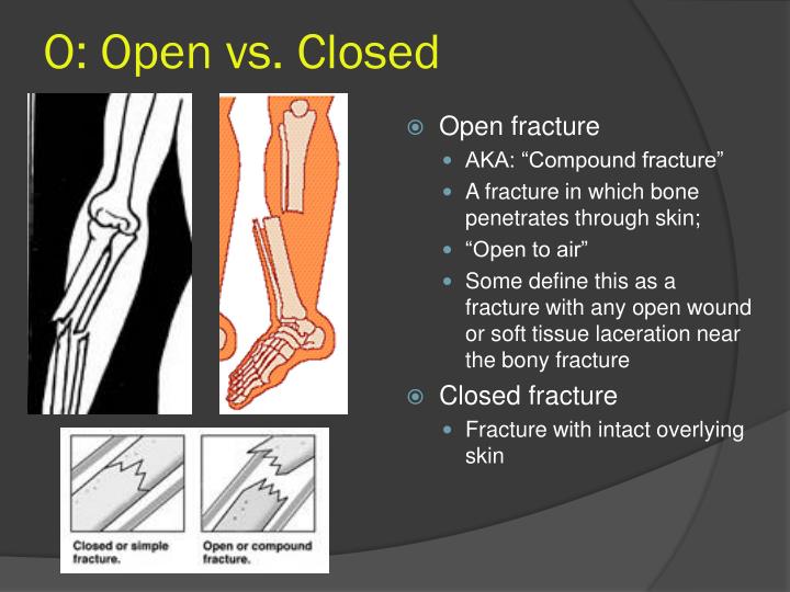 PPT Principles of Fracture Treatment PowerPoint Presentation ID6570825