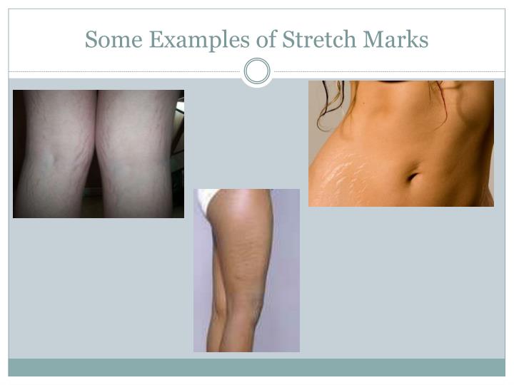 how to remove stretch marks within a week zero how to remove stretch marks within a week zero