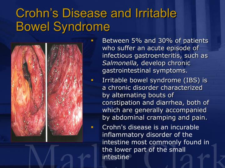 perfectionist irritable bowel syndrome and lower The most common symptoms of irritable bowel syndrome (ibs) are pain in your abdomen, often related to your bowel movements, and changes in your bowel movements these changes may be diarrhea, constipation, or both, depending on what type of ibs you have. perfectionist irritable bowel syndrome and lower The most common symptoms of irritable bowel syndrome (ibs) are pain in your abdomen, often related to your bowel movements, and changes in your bowel movements these changes may be diarrhea, constipation, or both, depending on what type of ibs you have.