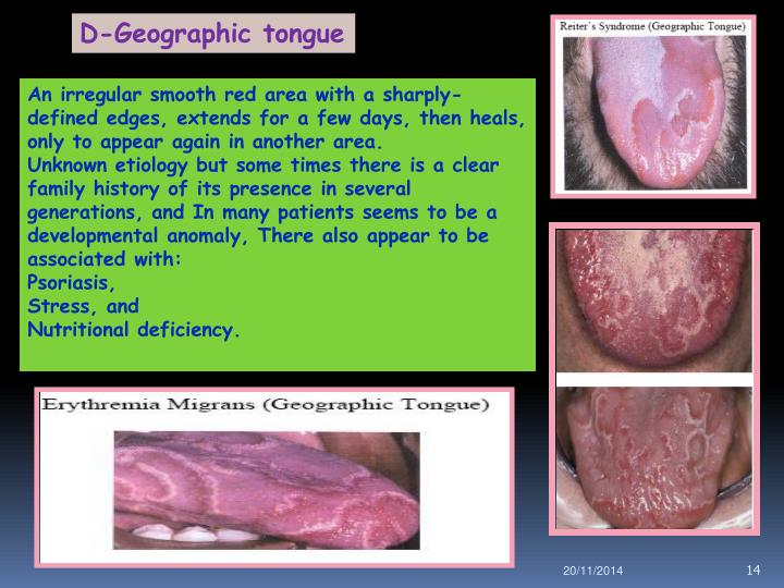 PPT - TOUGUE DISORDERS PowerPoint Presentation - ID:6909363