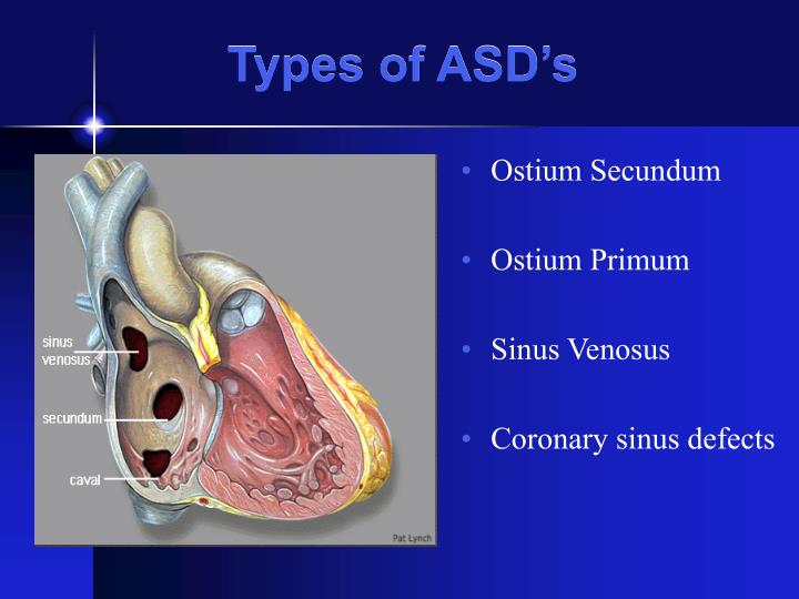 PPT - Atrial Septal Defects PowerPoint Presentation - ID ...
 Sinus Venosus Asd