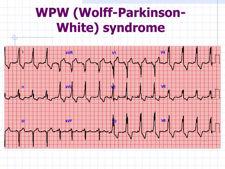 wolf parkinsons white syndrome