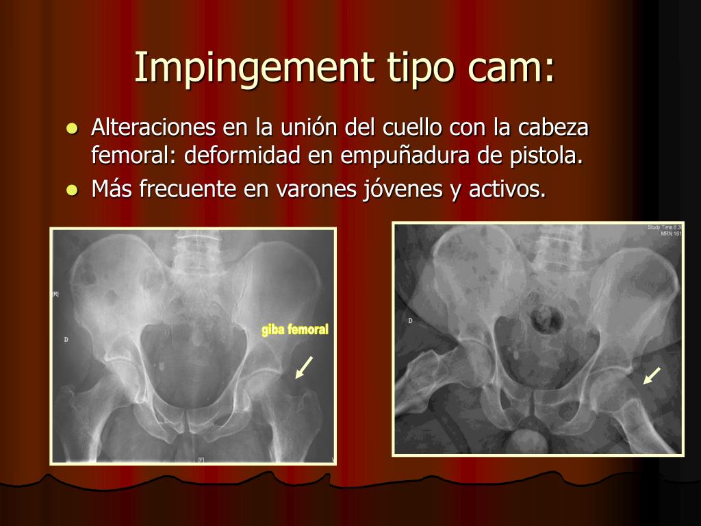 Ppt Artro Rm De Cadera Nuestra Experiencia Powerpoint Presentation Id5380102