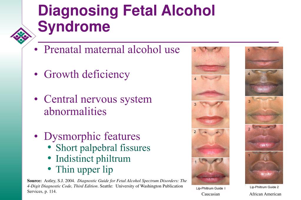 Adults With Fetal Alcohol Syndrome