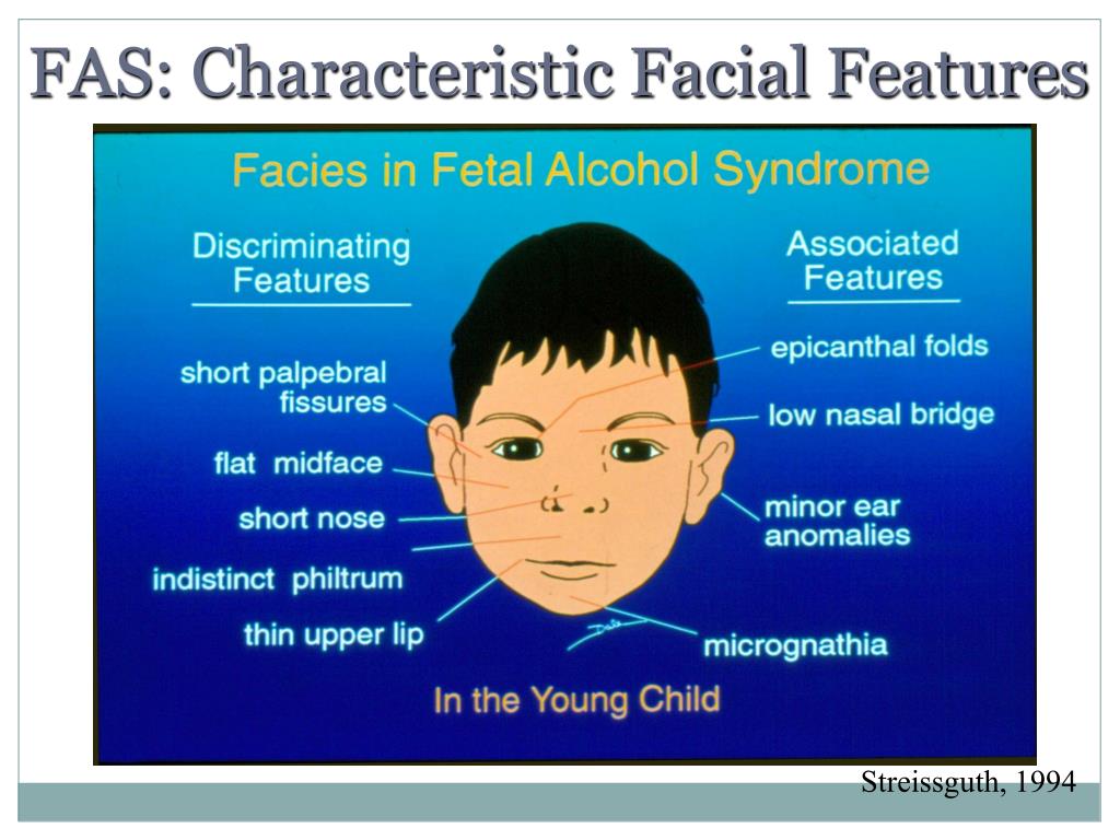Фетальный алкогольный синдром фото детей