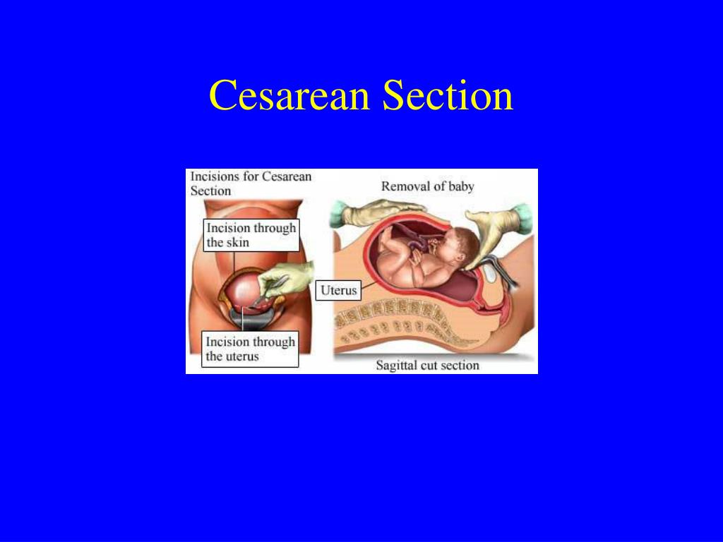 cesarean section abnormal presentation