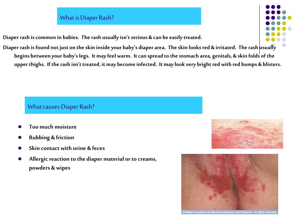PPT - What is Diaper Rash? PowerPoint Presentation, free ...