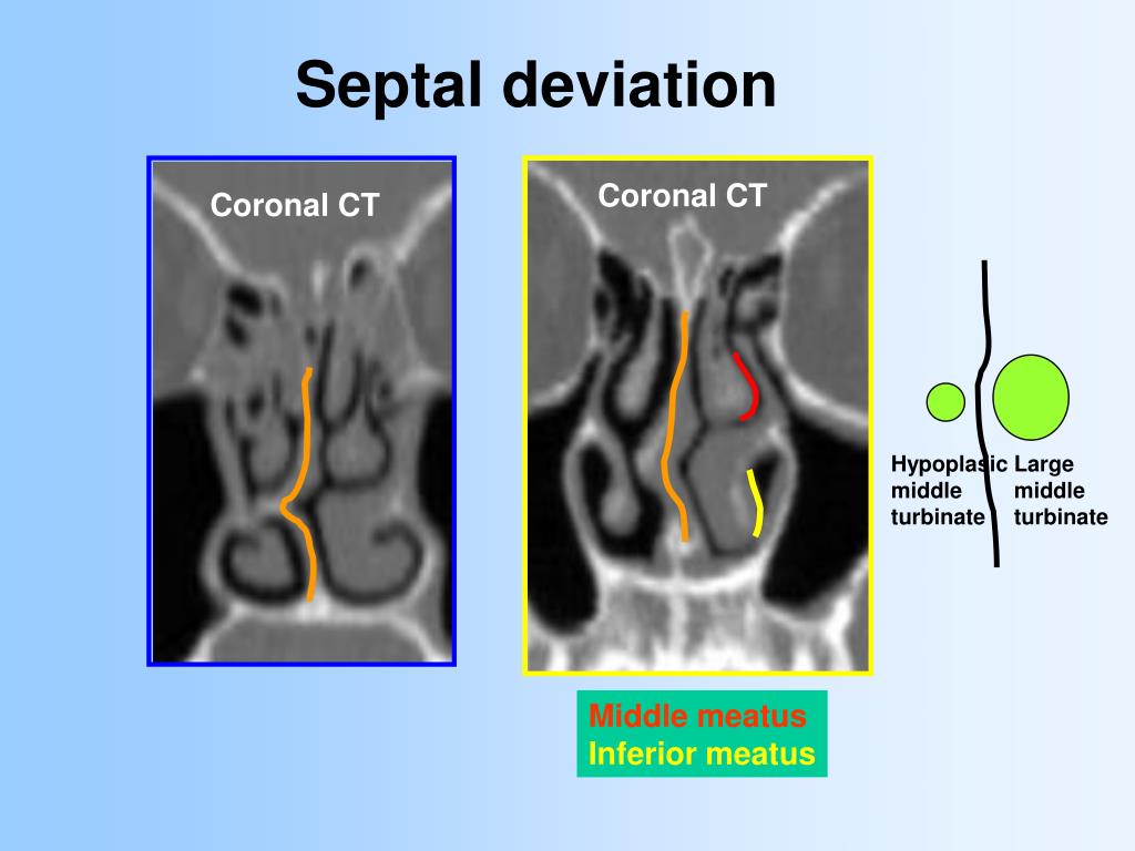 PPT Anatomy And Relevant Anatomical Variants In Nasal And Paranasal 