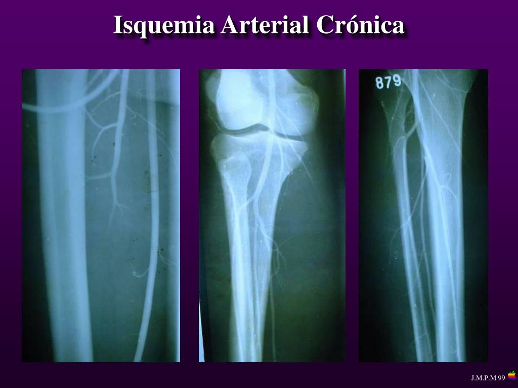 Ppt Isquemia Arterial Crónica Powerpoint Presentation Free Download Id5440568 7152