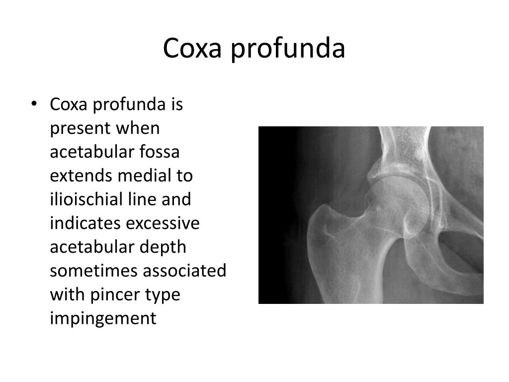 PPT HIP PAIN IN THE YOUNG ADULT PowerPoint Presentation Free PPT HIP PAIN IN THE YOUNG ADULT PowerPoint Presentation Free