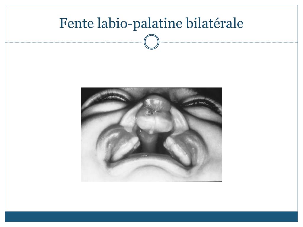 PPT Fente labiopalatine unilatérale PowerPoint Presentation, free download ID5447348