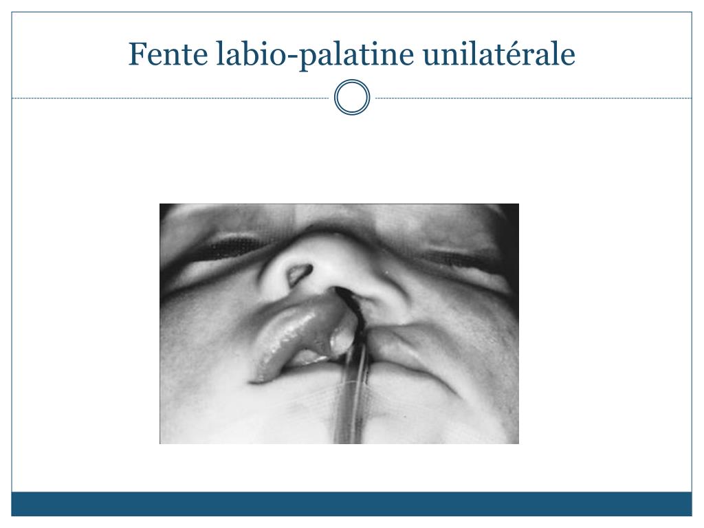PPT Fente labiopalatine unilatérale PowerPoint Presentation, free download ID5447348