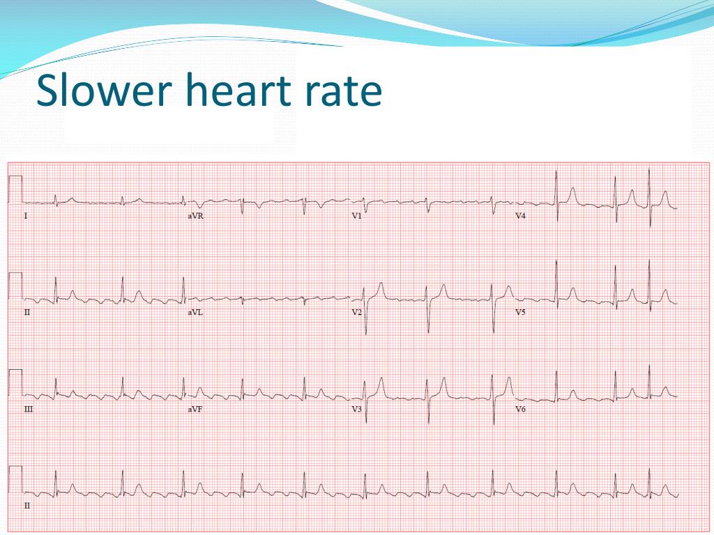 ppt-what-to-do-if-called-for-an-arrhythmia-powerpoint-presentation