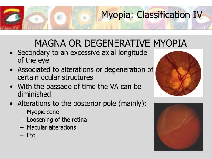 degenerative myopia bilateral