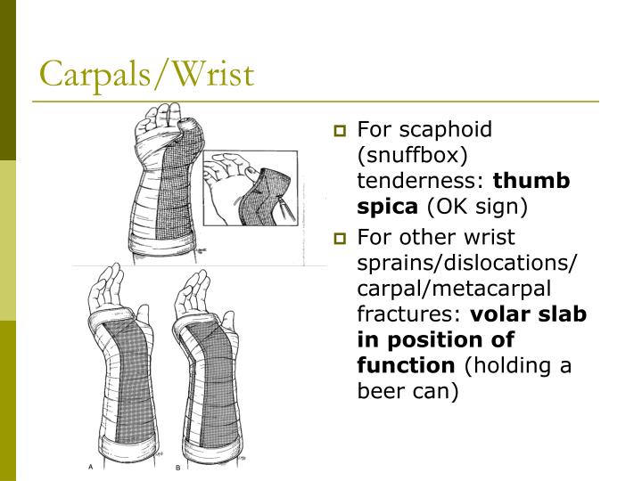 PPT - Splinting Seminar PowerPoint Presentation - ID:5465564