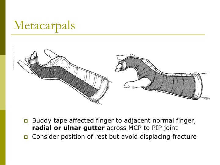 PPT - Splinting Seminar PowerPoint Presentation - ID:5465564