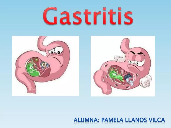 PPT Gastritis PowerPoint Presentation, free download ID5474429