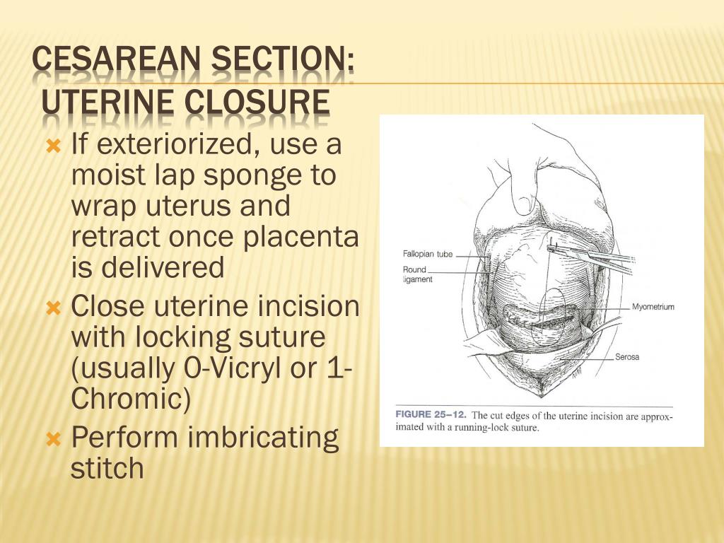 Ppt Cesarean Section Powerpoint Presentation Free Download Id5481243