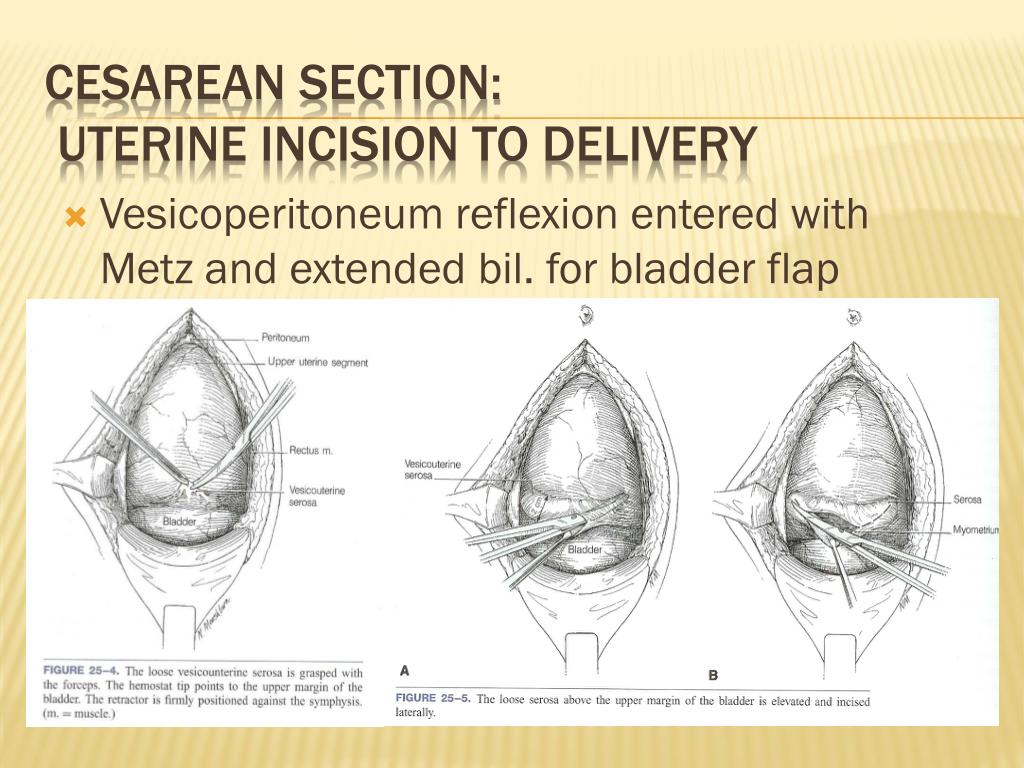 cesarean section in presentation