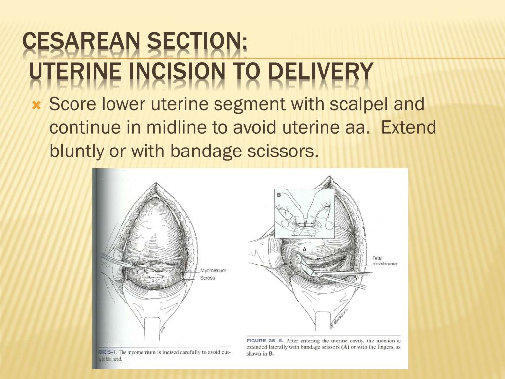 compound presentation cesarean section