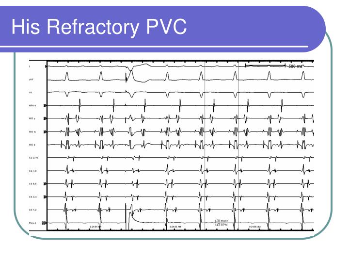 PPT - Differential Diagnoses Of SVT: Common EP Lab Techniques ...