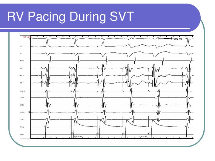 Ppt - Differential Diagnoses Of Svt: Common Ep Lab Techniques 