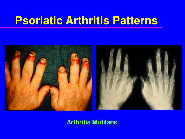 PPT - Psoriatic Arthritis Clinical Features and Epidemiology PowerPoint ...