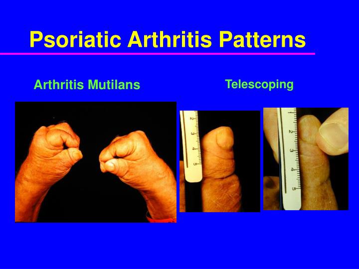 PPT Psoriatic Arthritis Clinical Features and Epidemiology PowerPoint