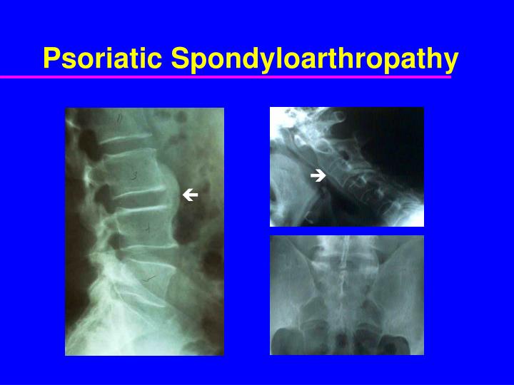 Psa Back PPT - Psoriatic Arthritis Clinical Features and Epidemiology PowerPoint ...