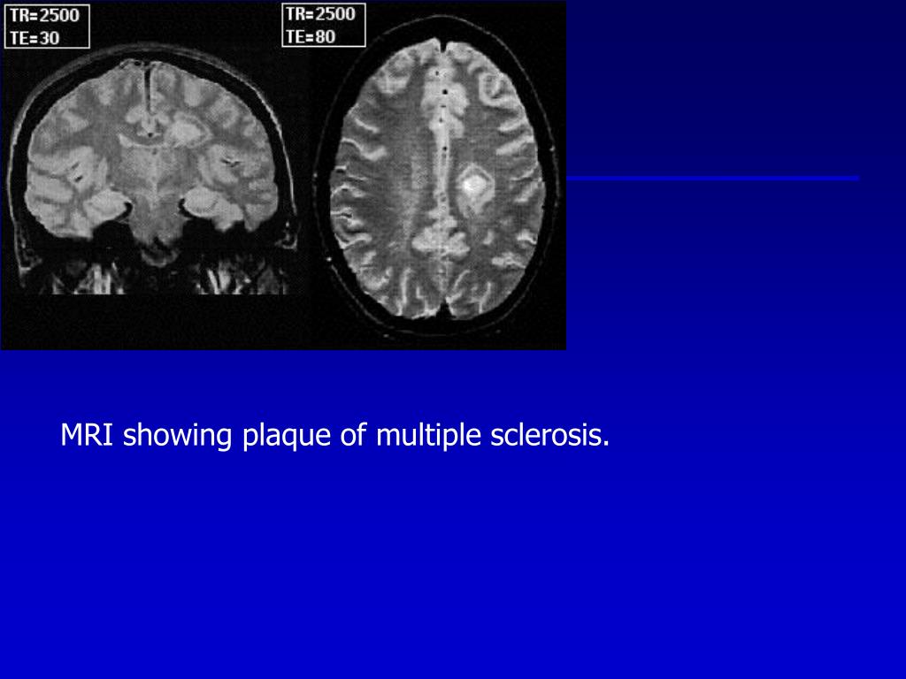 Ppt Mri Showing Plaque Of Multiple Sclerosis Powerpoint Presentation Id5490821