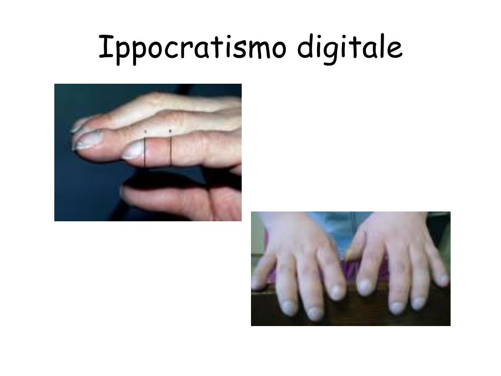 PPT NEOPLASIE POLMONARI PowerPoint Presentation Free Download ID PPT NEOPLASIE POLMONARI PowerPoint Presentation Free Download ID